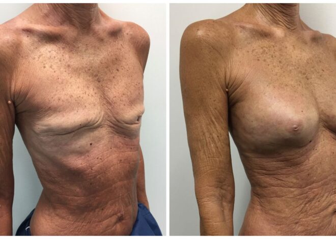 Fat Transfer Breast Augmentation: What to Expect Before, During, and After