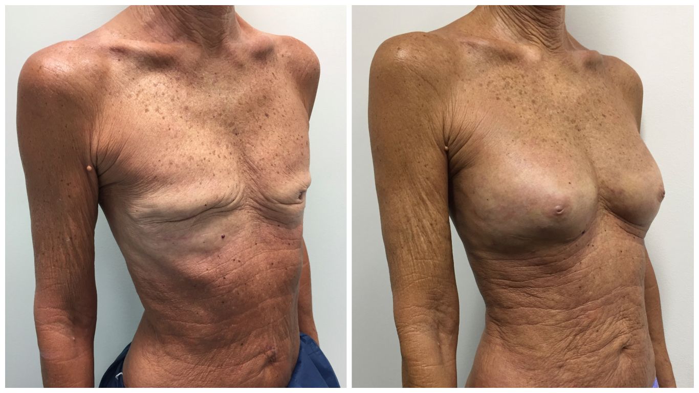 Fat Transfer Breast Augmentation: What to Expect Before, During, and After