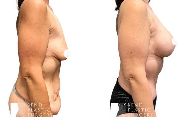 Fat Transfer Breast Augmentation: What to Expect Before and After