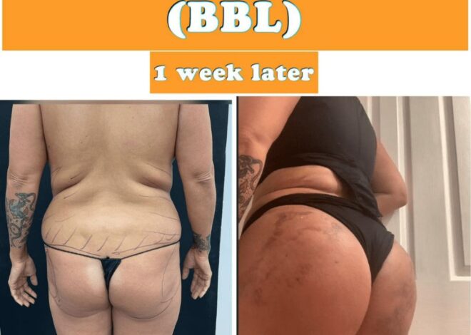 Fat Transfer to Butt: What to Expect from a BBL