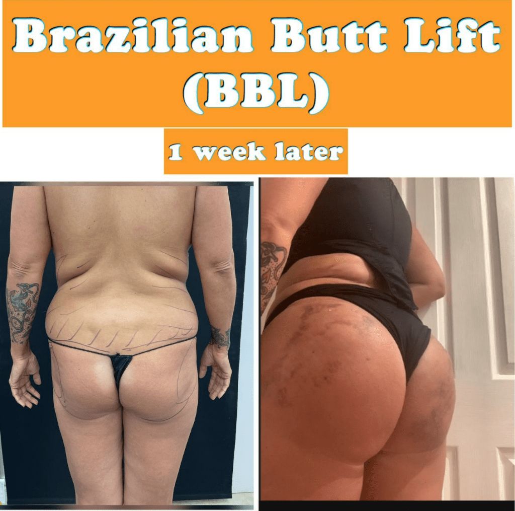 Fat Transfer to Butt: What to Expect from a BBL