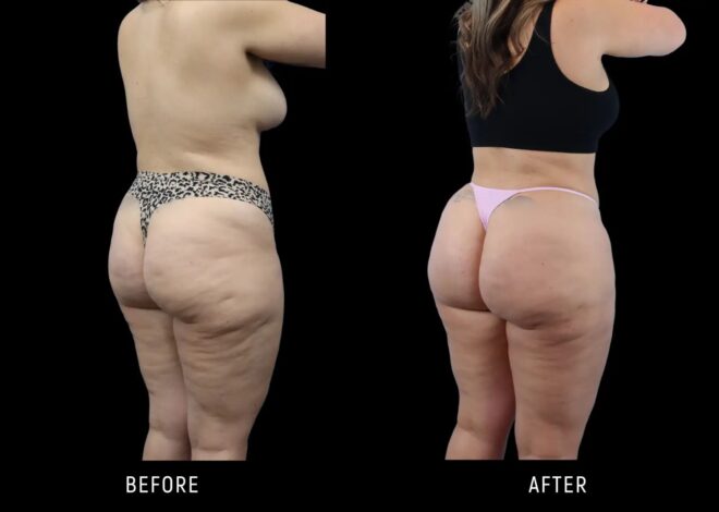 Fat Transfer to Buttocks Cost: What to Expect and How Carbs and Muscle Fit In