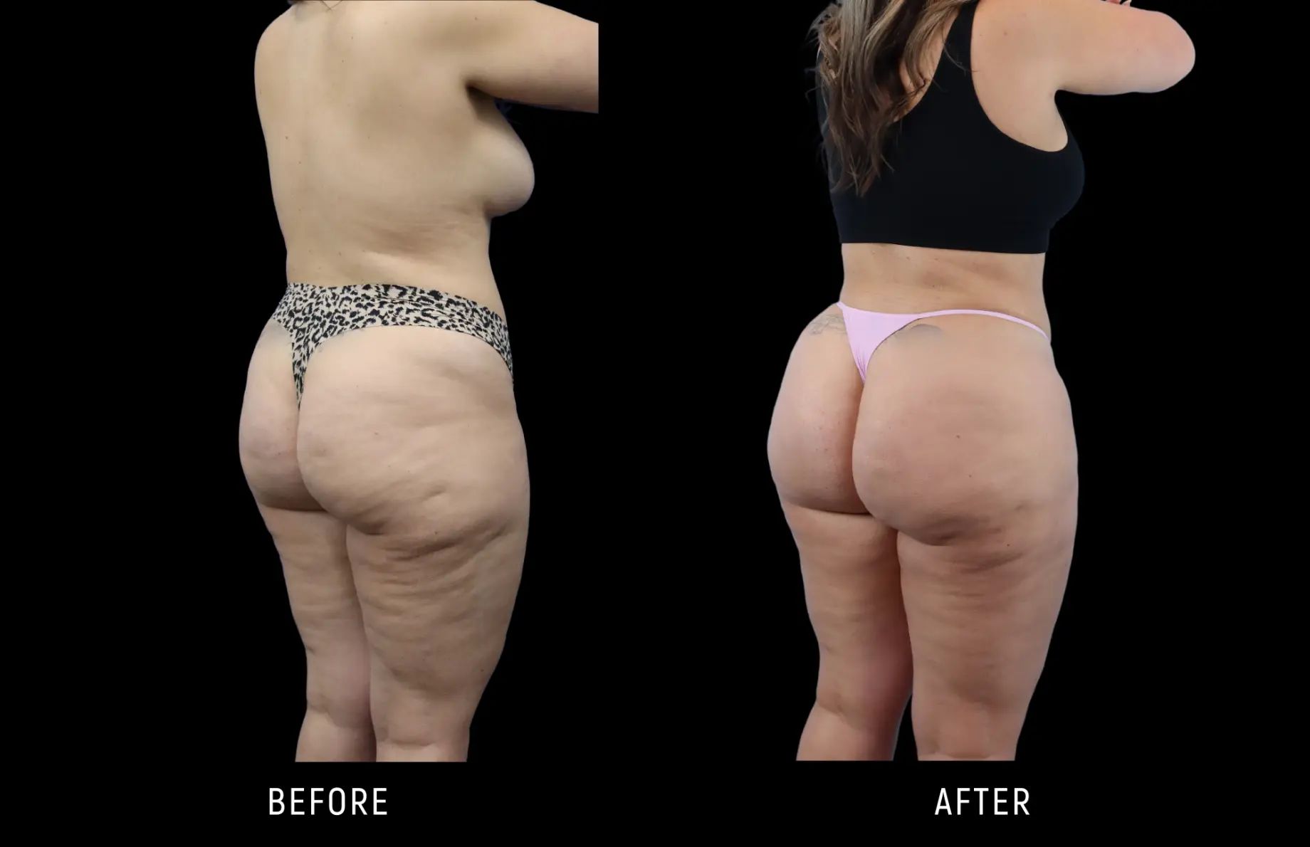 Fat Transfer to Buttocks Cost: What to Expect and How Carbs and Muscle Fit In