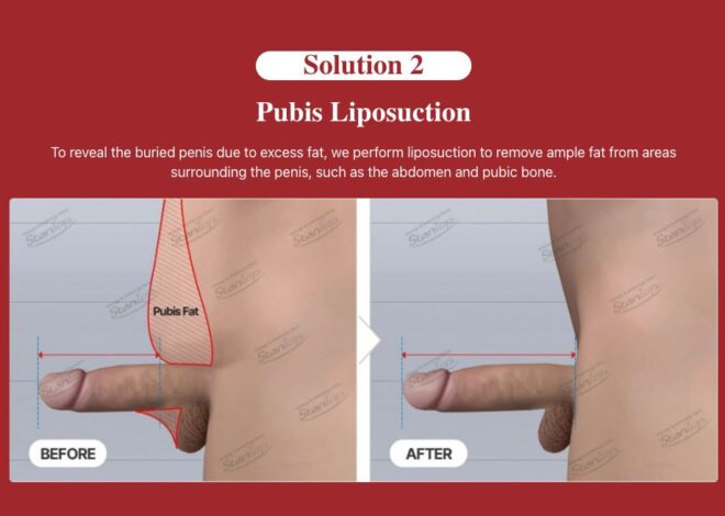 Mons Pubis Fat and Male Fat Pad: How to Lose Fat Around the Pubic Area