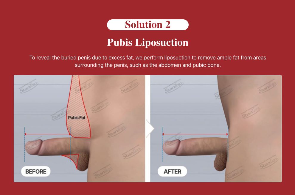 Mons Pubis Fat and Male Fat Pad: How to Lose Fat Around the Pubic Area