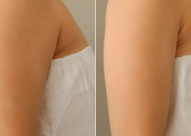 Fat Freezing Before and After: CoolSculpting Results and the Fat Golfer Phenomenon