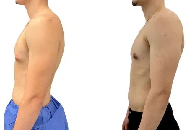How to Get Rid of Side Boob Fat and What Skinny Fat Really Looks Like