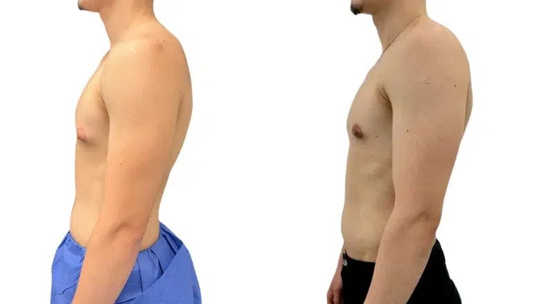 How to Get Rid of Side Boob Fat and What Skinny Fat Really Looks Like