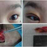 orbital fat prolapse and fat owl