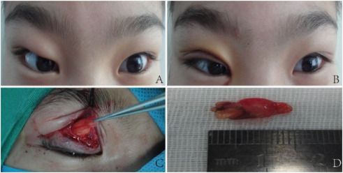 Orbital Fat Prolapse: Understanding the Impact on Nutrition