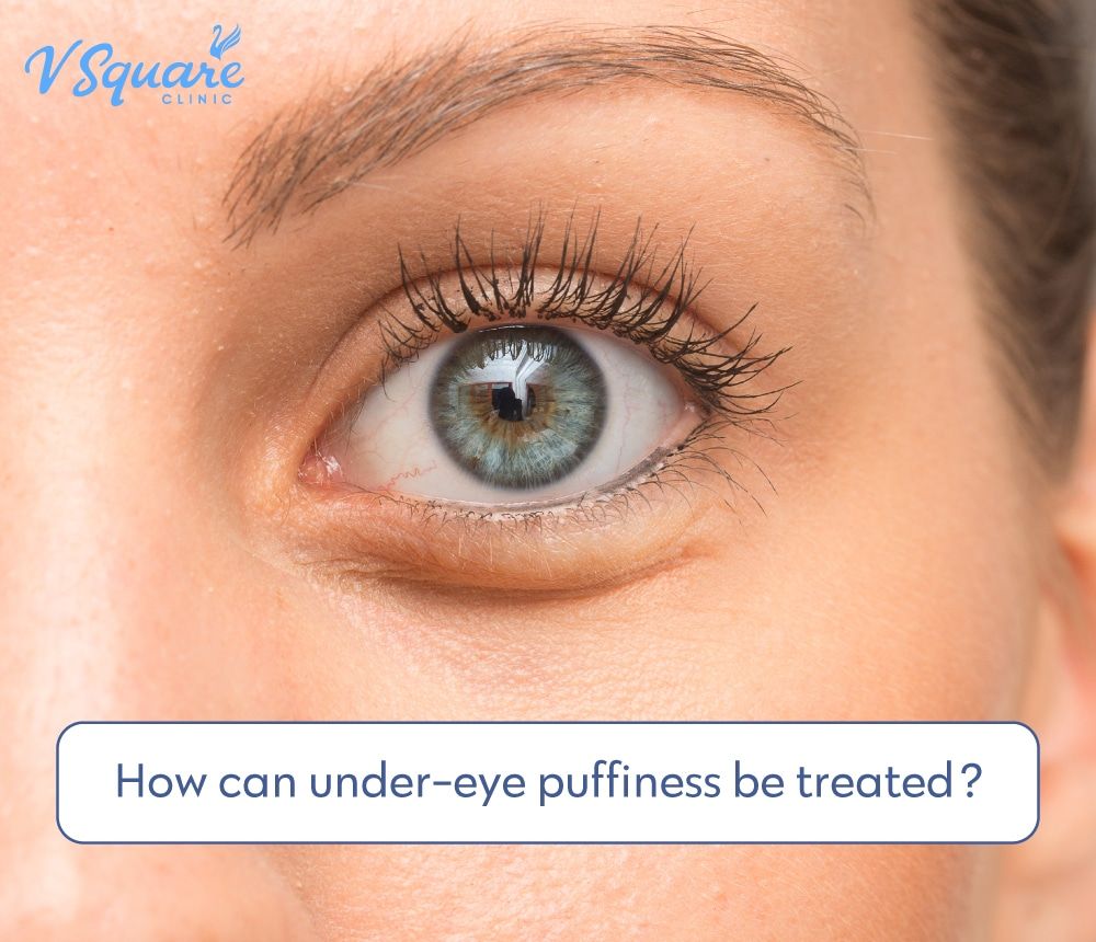 Fat Deposits Under Eyes: Causes and Solutions