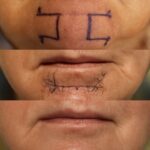 Mohs surgery and Mohs procedure on face