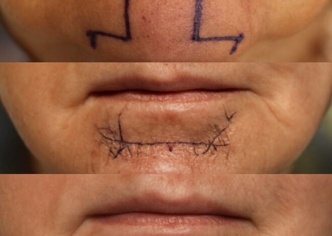 Mohs Surgery: A Comprehensive Guide to Skin Cancer Treatment
