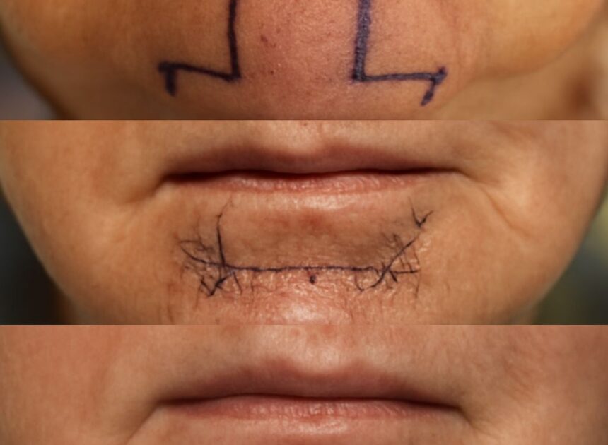Mohs Surgery: A Comprehensive Guide to Skin Cancer Treatment